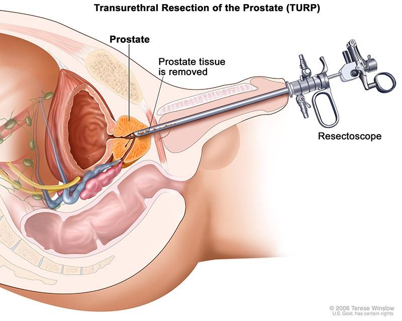 TURP Treatment for BPH in Alexandria VA Potomac Urology